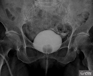 膀胱生検の準備方法